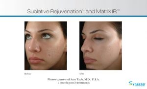 , eMatrix &#8211; Skin Rejuvenation
